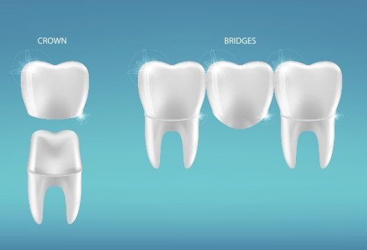 What’s the Difference Between Dental Crowns and Bridges?